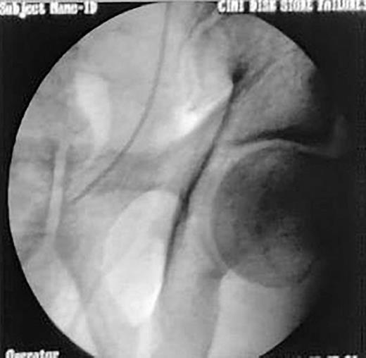 Fluoroscopy image of the distal end of ureteral stent. Refer to the image caption for details.