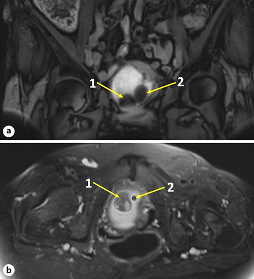 MRI of the pelvis. a T1. b T2 sagittal section. In both panels, “1” indicates the 2.8 × 2.4 × 2.0 cm suspected lesion and “2” indicates the urinary catheter.