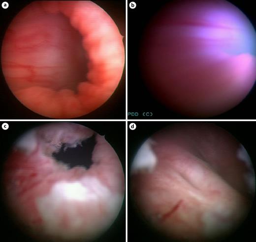Cystoscopic identification of the lesion. a Obstructed bladder neck (preresection). b Photodynamic diagnosis. c Results after surgical resection. d Postoperative view with the anatomical ureteral opening on both sides. Refer to the image caption for details.