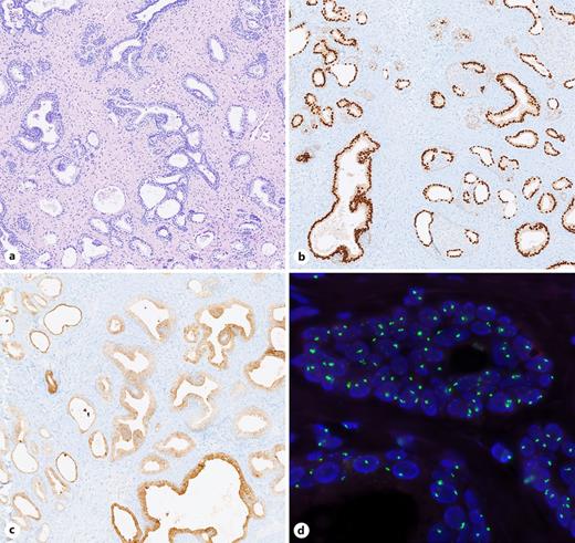 Histopathology. Scale bar (a-c): 500 μm. a H&E staining showing a glandular architecture and fibrous stroma with a prostate-like configuration. b Epithelial cells are strong nuclear positive for NKX3.1. c PSA staining displays a cytoplasmic positivity in the epithelial cells. d In the FISH analysis, two green signals (X chromosome) are visible with no orange signals (Y chromosome), confirming an XX karyotype. Refer to the image caption for details.