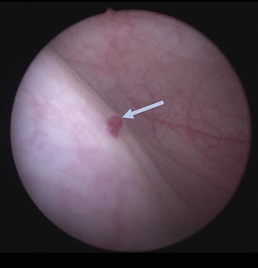 Cystoscopic view of small bladder hemangioma (arrow). Refer to the image caption for details.