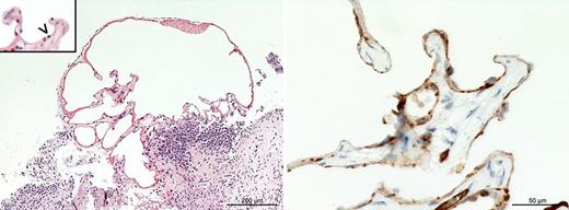 Histology of a bladder hemangioma. Left: HE shows a thin-walled vascular lesion with numerous dilated capillaries with an eroded surface and flattened endothelium (arrowhead, inset). Right: CD31 immunohistochemistry labels the flattened endothelium (brown).