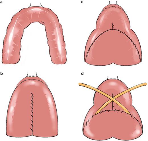 Surgical procedures for the construction of “Shell” neobladder. a Anastomosis between the urethra and the ileal tract identified for the future neobladder. b Configuration of the posterior plate. c Ureteral-neobladder anastomoses. d Configuration of the anterior plate.