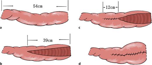 Surgical procedures for the construction of IUPU neobladder. a Take a 54-cm section of ileum. b The distal 39 cm of the ileum was detubularized along the antimesenteric border and folded at the mark points. c First fold of the distal ileal segment with the two 12-cm segments sutured together. d Second fold, forming the posterior wall of the neobladder and closing the anterior wall of the neobladder.