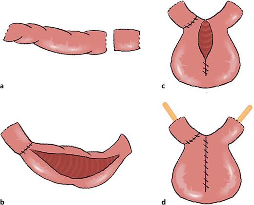 Surgical procedures for the construction of Xing’s neobladder. a A 60-cm ileum from approximately 25 cm proximal to the ileum was taken, and 10 cm of proximal ileum was excised. b The excised proximal 10 cm of ileum was flipped to the right and anastomosed to the distal bowel, leaving a segment of bowel of equal distance distally and to the left to complete the bilateral pass to the isoperistaltic limb, and the remaining bowel in the center was broken off and detubulated. c, d The anterior and posterior walls of the neobladder were sutured, and the ureter was anastomosed. Refer to the image caption for details.