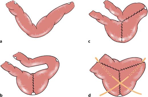 Surgical procedures for the construction of VON. a Take a 36-cm-long segment of ileum. b, c A 60-mm stapler is introduced through the first incision to make the caudal horn, followed by a second 60-mm stapler through the second incision for the left horn. d After removal of the central part of the metal suture exceeding the intestinal resection, the afferent and efferent stumps are sutured together with a 60-mm mechanical stapler forming the right lateral horn; the ureter is placed on the same side of the horn, and then the ureteral catheter is reversed through the anterior wall of the neobladder.