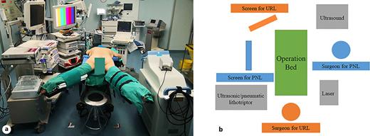 Operation room setup. Before the initiation of the procedure, patients were kept in the prone split-leg position to avoid the extra time for repositioning. The real (a) and virtual (b) operation room setup was shown to perform an SBES in prone split-leg position of right PNL and left URS. SBES, simultaneous bilateral endoscopic surgery; PNL, percutaneous nephrolithotomy; URS, ureteroscopic lithotripsy.
