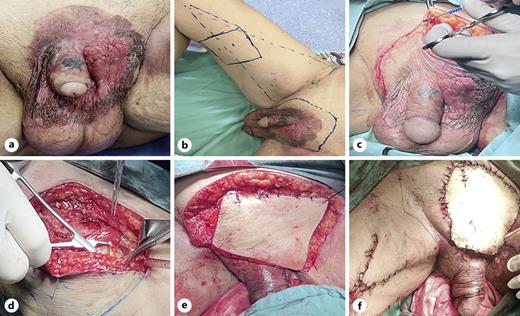 a The skin lesion manifestation. b Marking the surgical margin. c The 2 cm outside the skin lesion was used as the initial surgical margin to excise the lesion. d Skin flap is obtained from the medial thigh near the inguinal region. e Free skin flap transplantation was used to repair the surgical wound. f Postoperative manifestation.