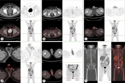  a Metabolic status of bilateral inguinal lymph nodes. b The metabolism of the left inguinal lymph node is increased. c, d The scrotal skin on both sides was thickened and the metabolism was increased, especially on the left side. e The density and metabolism of left testis were increased, considering tumor invasion. f Metabolic status of whole body tissues. a-f PET/CT results showed that the skin of bilateral scrotum was slightly thickened with increased metabolism, and the density and metabolism of the left testis were increased, which were considered as tumor invasion. Refer to the image caption for details.