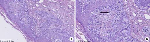 a Pathological images of the lesion showed Paget disease involving the epithelium of the skin (HE satin ×100 magnification). b Many scattered vacuolated Paget cells (black arrow) were observed in the epidermal layer, which have large cell bodies, abundant and light-stained cytoplasm, large and dark-stained nuclei. Moreover, abnormal mitotic images were observed in Paget cells.