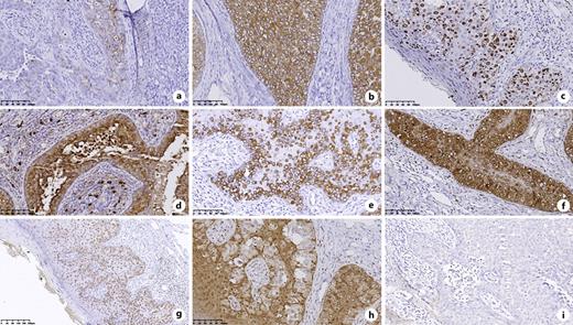 Immunohistochemical staining of EMPD lesion (×200 magnification). a Weakly positive staining for GCDFP-15. b Positive staining for CK7. c Positive staining for KI-67. d Positive staining for MUC5AC. e Positive staining for CK20. f Positive staining for CEA. g Positive staining for GATA3 (×100 magnification). h Negative staining for CK5/6. i Negative staining for Ber-EP4.