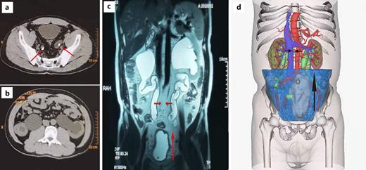 Imaging manifestations of patients with PL and schematic diagram of modified ileal conduit surgery. a CT scan showed increased fat around the bladder, bilateral ureters compressed by fat. b CT scan showed severe hydronephrosis in bilateral renal pelvis and ureters. c MRI indicated that the bladder was deformed and elongated, the position was raised, and the ureter shifted to the middle. d Three-dimensional reconstruction model of CTU.