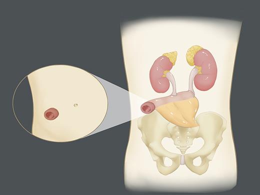 Schematic diagram of modified ileal conduit surgery.