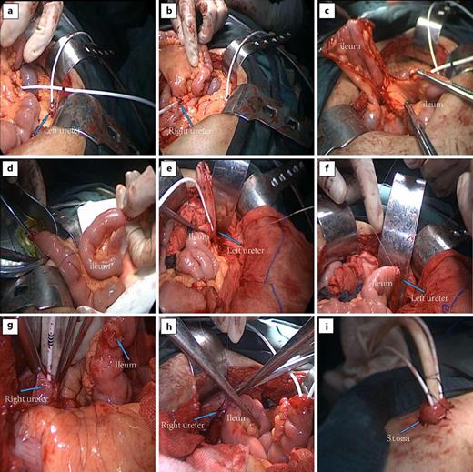 Description of modified ileal conduit surgery for PL. a, b The left and right ureters were fully dissociated to the level of the lower pole of the kidney, and a ureteral stent was placed, respectively. c, d A 25 cm-long ileum was isolated and excised near 15 cm from the ileocecal part to make the ileal conduit and the continuity of the original bowel was restored. e, f At the level of the lower pole of the left kidney, the incised left ureteral orifice was anastomosed end-to-end with the proximal ileal conduit. g A small hole was cut near 10 cm from the proximal end of the ileal conduit. h The incised right ureteral orifice was anastomosed with the ileal conduit at the level of the lower pole of the right kidney. i The distal end of the ileal conduit and the ureteral stent were pulled out of the abdominal wall together, and the distal end was sutured into a papillary shape and fixed with the abdominal wall.