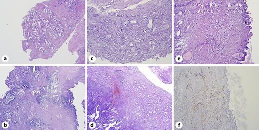 Histological images of iPCa. a HoLEP: benign histology (hematoxylin/eosin staining, magnification ×40). b Aquablation: benign histology (hematoxylin/eosin staining, magnification ×40). c HoLEP: iPCa, Gleason score 6 = 3 + 3 (hematoxylin/eosin staining, magnification ×100). d HoLEP: iPCa, Gleason score 7a = 3 + 4 (hematoxylin/eosin staining, magnification ×20). e Aquablation: iPCa, Gleason score 8 = 4 + 4 (hematoxylin/eosin staining, magnification ×200). f Aquablation: iPCa, Gleason score 8 = 4 + 4 (PSAP immunohistochemistry, magnification ×200).
