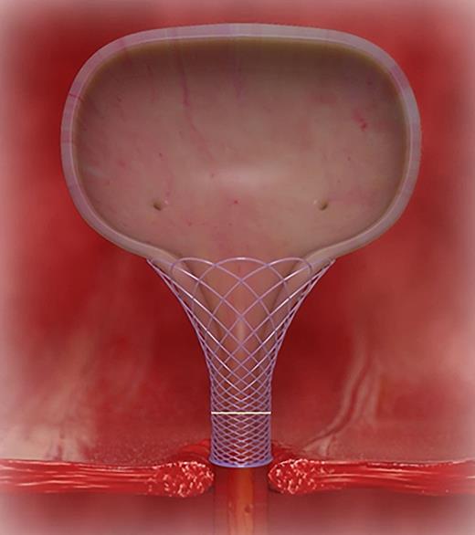 Absorbable urologic scaffold positioned over the anastomotic site between the bladder neck and urethral stump. The yellow line indicates the location of the anastomosis between the urethra and the bladder neck. Refer to the image caption for details.