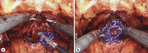 a Prior to performing the anastomosis, the urologic scaffold (purple) is inserted in a compressed state. b Following placement over the ureteral stump, the urethra is shown projecting through the central lumen of the scaffold prior to anastomosis. The anastomosis is subsequently performed through the device.