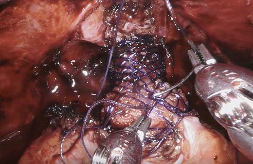 Suture placement to secure urologic scaffold in place following creation of the anastomosis.