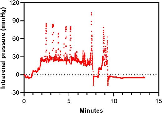 Data generated from flexible ureteroscope with real-time intrarenal pressure (IRP) sensing. Key data include procedure time of 13.5 min, mean IRP of 12 mmHg, peak IRP of 103 mmHg, and 65 s spent at IRP >30 mmHg.