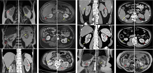 CT/MRI scans of all patients in the cohort. The red arrows indicate the tumors treated with OPN, and the yellow arrows indicate the tumors treated with RAPN. Refer to the image caption for details.