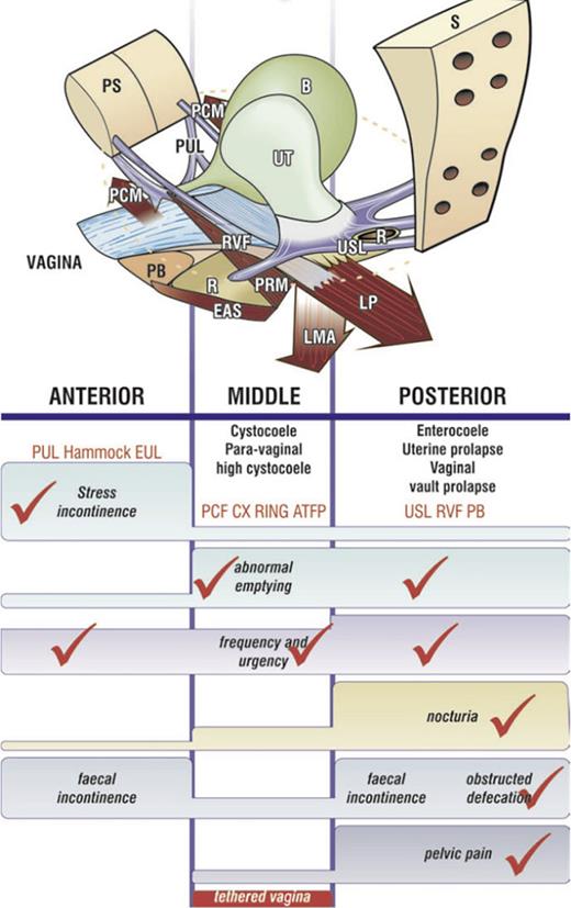 The pictorial diagnostic algorithm represents three zones of connective tissue causation. Positive symptoms (even “sometimes”) are ticked in each column where they occur, and the causative prolapse and ligaments emerge. The prolapses in the algorithm correlate with ligament damage in the columns. Symptom groupings in the 3 columns help to deduce which ligaments cause which symptoms and serve as a guide to surgical repair of the ligaments. Pelvic pain and nocturia are only caused by uterosacral ligament (USL) laxity. Severe stress incontinence is caused mainly by pubourethral ligament (PUL) laxity. Hammock, suburethral vaginal hammock; EUL, external urethral ligament attached to the external urethral meatus; CX ring represents cardinal ligament insertion onto the anterior part of the cervical ring; PCF, pubocervical fascia; RVF, rectovaginal fascia; PB, perineal body; LP, levator plate; LMA, conjoint longitudinal muscle of the anus; EAS, external anal sphincter; PRM, puborectalis muscle; PCM, pubococcygeus muscle; R, rectum; UT, uterus; B, bladder; PS, pubic symphysis; S, sacrum. Refer to the image caption for details.