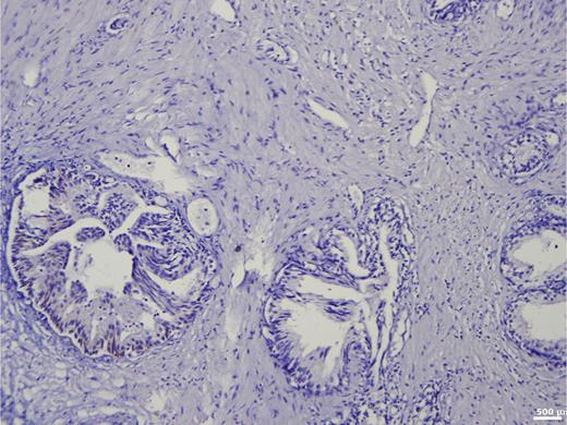 Immunohistochemistry in prostate tissue without carcinoma and without basal cell hyperplasia. Refer to the image caption for details.