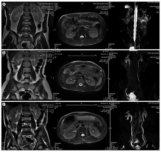 MRU UUTD grades 0-2. a Grade 0 UUTD: MRU reveals no separation of the central renal complex of the kidneys and no dilation of the ureters. b Grade 1 UUTD: MRU reveals slight separation of the central renal complex of the kidneys and the ureters are <7 mm in diameter. c Grade 2 UUTD: MRU shows that the renal pelvis of the left kidney is further dilated, a few calices may be visualized and the left ureter is <10 mm in diameter.
