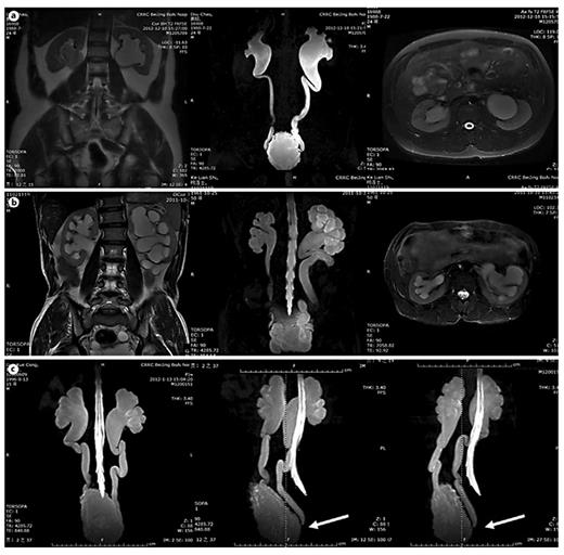 MRU UUTD grades 3-4 and distal ureteral obstruction. a Grade 3 UUTD: MRU shows that the renal pelvis is dilated, there are fluid-filled calices throughout the left kidney, the renal parenchyma overlying the calices has thinned (renal parenchyma loss <50%), and the left ureter is tortuous and <15 mm in diameter. b Grade 4 UUTD: MRU shows that the bilateral renal pelvises are seriously dilated, there are fluid-filled calices throughout the kidneys, the renal parenchyma over the calices is thinned (renal parenchyma loss >50%), and the bilateral ureters are severely tortuous and >15 mm in diameter. c Distal ureteral obstruction: HN and UD can be displayed during 360° rotation, and vesicoureteral junction stricture or obstruction can be clearly shown (arrows: left and right ureters).