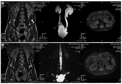 Improvement of UUTD grades by MRU after 6 months of augmentation enterocystoplasty. a Preoperative UUTD grades of right and left kidneys were 3 and 4, respectively. b Postoperative UUTD grades of right and left kidneys became 0 and 1, respectively. A significant improvement is shown.