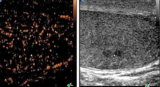 Fig. 1. B-mode (right side of figure) and contrast-enhanced ultrasonographic (CEUS, left side) images of left testis of patient #1. The white dot denotes a small hypo-echoic lesion suspicious of neoplasia in the B-mode scan. However, CEUS does not reveal any enhancement of air bubbles in the corresponding region, and thus the presence of a testicular tumour was excluded.