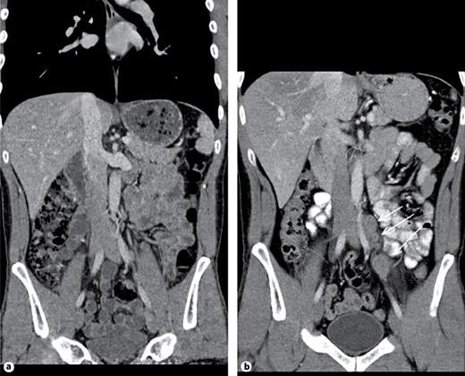 Fig. 2. a Patient #3, left-sided testicular seminoma. Abdominal CT reveals unspecific small lymph node lateral to left iliac artery. Radiological diagnosis: no metastases detected. b Same patient, abdominal CT 26 months after adjuvant Carboplatin treatment: a chain of enlarged lymph nodes lateral to left iliac artery (arrows). Diagnosis: retroperitoneal relapse of seminoma.