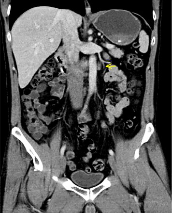 Fig. 3. Abdominal CT of patient #4, 4 months after orchiectomy: para-aortal lymphadenopathy. Laparoscopic excision revealed seminoma.