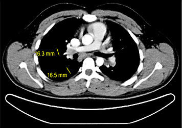 Fig. 4. Chest CT of patient #5 after 4 cycles of cisplatin-based chemotherapy: hilar lymphadenopathy. Transbronchial biopsy revealed sarcoidosis.