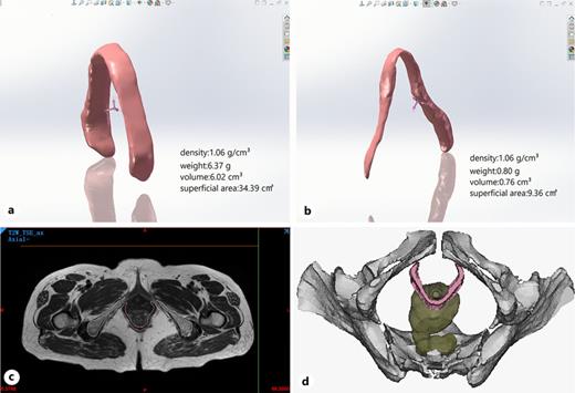 Parameters of the pubic visceral muscle. a Parameters of the pubic visceral muscle in non-POP patients. b Parameters of the pubic visceral muscle in POP patients. c In the MRI image, the border is outlined as the pubic rectal muscle, the brown-green circle is the rectum, and the white is the pelvic part. d Mimics 3D reconstruction of the pubic rectal muscle (pink), rectum (brown and green), and pelvis (white). POP, pelvic organ prolapse.