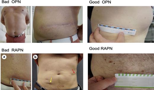 Exemplary pictures of scars after OPN and RAPN. Top left: Symptomatic relaxation and hypertrophic, hypopigmented scar after OPN. Top right: Thin and short scar rated POSAS 14 after OPN. Bottom left: Hypertrophic scar with hyperkeratotic specimen extraction site (a) and irregular relief (b; yellow) at the specimen extraction site after RAPN, especially compared to the OPN scar (b; red). Bottom right: Almost invisible scar of the robotic port due to abdominal skin hair after RAPN.