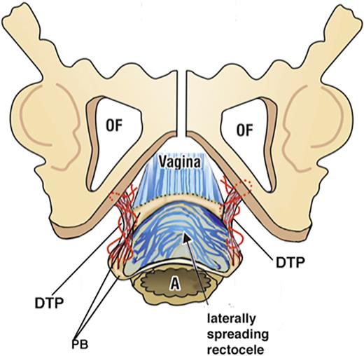 Anatomy of the descending perineal syndrome. Surgery to locate and repair the DTPs (deep transversus perinei) which are the suspensory ligament of the perineal body requires a much wider dissection. Exposure of a widely laterally displaced perineal body and elongated deep transverse perineal ligament supports is made by a 5-cm full-thickness transverse incision made just inside the hymenal ring. With descending perineal syndrome, the serosa and smooth muscle wall of the rectum are ruptured, and the rectal mucosa is spread to become adherent to the vagina and deep transversus perinei. Careful dissection is required to separate the rectal mucosa. Two to three interrupted sutures close the smooth muscle layer. The DTP is identified and repaired. As the DTP shortens, the perineal bodies fold inward and are gently approximated. The vagina is sutured without excision of tissue (as shown in doi: 10.21037/atm-23-1803). DTP, deep transversus perinei.