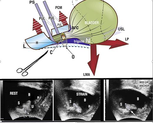 Restoration of continence by PUL support. Upper image shows SUI. If PUL is weak, it lengthens to “L” on effort and cannot hold the posterior urethral wall and vagina (to which it is attached) against the powerful LP/LMA opening forces; PCM cannot stretch the distal vaginal hammock “H” forward sufficiently to close the distal urethra from behind; LP/LMA forces stretch the trigone backward to open “H” and the posterior urethral wall, from “C” (closed) to “O” (open), broken lines. The hemostat mimics what a suburethral sling does; it prevents PUL extension to “L” and restores urethral closure, as seen in the right ultrasound frame (white arrow). Lower images show transperineal ultrasound in a patient with SUI. Rest (left image): three small white circles represent PUL. The organs are in the correct anatomical position. S, symphysis; U, urethra; a & p, anterior and posterior vaginal walls. Strain (middle image): note elongation of PUL on straining (4 white circles). The funneling of the bladder neck and expansion of the urethral diameter along the whole urethra exponentially lowers the urethral resistance to urine flow and urine is lost on coughing. Hemostat test (right image): the white arrow represents the hemostat. The hemostat mechanically supports a weak PUL, prevents elongation “L”, and prevents opening by LP/LMA to cause SUI.