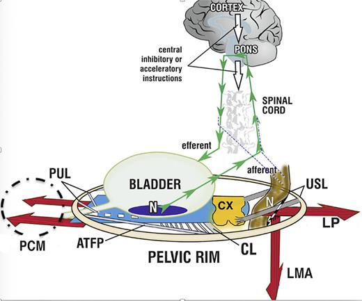 The binary cortico/peripheral control systems of bladder and bowel are virtually identical. Afferent impulses from stretch receptors “N” in the bladder and bowel proceed to the brain which interprets them as “fullness.” By reflexly stretching bladder and bowel bidirectionally (large arrows), the muscles tension the underlying supports of the stretch receptors “N” of the bladder or rectum to support their contents; this prevents them from firing off emptying impulses prematurely, thereby controlling inappropriate activation of the micturition and defecation reflexes, sensed by the cortex as “urge to go.” If convenient to empty, the closure reflex shuts down, and the emptying reflexes (micturition and defecation) are activated. The posterior walls of the urethra and anorectum are actively pulled open (broken lines) by LP/LMA immediately prior to evacuation. This external opening exponentially decreases resistance to flow, thereby facilitating evacuation. Dysfunction. Anatomical damage to any part of the system may interfere with the binary control of all the above functions. Cortex: facilitatory or inhibitory centers; nerves: afferent or efferent (for example, MS); peripheral: ligament or muscle damage; pressure or inflammation on stretch receptors “N” by cancer, cervical fibroid, bladder or rectal prolapse. Surgical cure. “Repair the structure (ligaments, vagina) and you will restore the function” (1). The diagnostic algorithm (as shown in Fig. 2) indicates which ligaments or fascias may be damaged. USL (as shown in Fig. 5) and PUL (as shown in Fig. 6) can be tested for symptom improvement by mechanical support, thereby predicting a high possibility of cure. PUL, pubourethral ligament; USL, uterosacral ligament; CL, cardinal ligament; N, bladder base and anorectal stretch receptors; LP, levator plate; LMA, conjoint longitudinal muscle of the anus; EAS, external anal sphincter; PCM, pubococcygeus muscle.