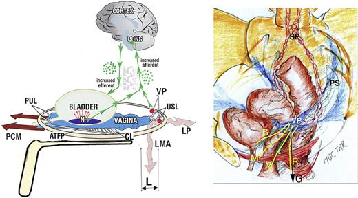 A “simulated operation” relieves pain and urge by supporting the uterosacral ligaments “USL.” Left image shows 3D view of PUL and USL attachments to the pelvic brim. “L” denotes USL laxity. A gently inserted speculum mechanically supports lax USLs and pelvic visceral nerve plexuses “VP.” The test, if successful, decreases afferent pain and urge impulses; the patient reports lessening or disappearance of pain in multiple sites, for example, B, R, M (right image). Co-occurring urge is also often relieved by speculum support of urothelial stretch receptors “N.” Right image shows 3D view of pelvic organs. VP comprises the sympathetic plexus “SP,” and the parasympathetic plexus “PS.” The yellow lines represent visceral nerves to and from the end organs, M (muscles), V (vagina/vulva), B (bladder), R (rectum) converging on VP, which acts as a relay station on their passage to the spinal cord and brain. G, force of gravity acting on VPs; PCM, pubococcygeus muscle; PUL, pubourethral ligament; LP, levator plate; LMA, conjoint longitudinal muscle of the anus.