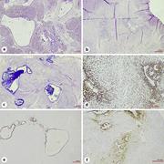 a Endocervical glands within the muscularis propria of the bladder (H&amp;E, ×20). b Endometrial glands surrounded by endometrial stroma in the bladder wall (H&amp;E, ×40). c Intense blue staining of apical mucin in the endocervical epithelium by PAS-Alcian Blue stain (×20). d Nuclear staining for ERs in the endocervical epithelial cells (×40). e Nuclear staining for ERs in the endometrial epithelial and stromal cells (×100). f CD10 staining in the stroma surrounding the endometrial glands (×40). H&amp;E, hematoxylin and eosin; ER, estrogen receptor.