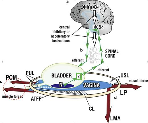 Binary model of bladder function. Schematic 3D sagittal view; system in normal closed mode. a Cortical binary control of OAB: afferent impulses “X” from stretch receptors “N” are reflexly suppressed cortically (white arrows). When required, the cortex activates the micturition reflex to evacuate bladder. b Peripheral binary control of continence is by a musculo‐ligamentous mechanism which responds to cortical efferents (small arrows) to stretch vagina in opposite directions to support “N” and decrease afferent impulses “X.” The three directional muscles (large arrows), forward, pubococcygeus muscle “PCM,” backward, levator plate “LP,” downward, conjoint longitudinal muscle of the anus “LMA” contract against the supporting ligaments, PUL (pubourethral) and USL (uterosacral), to stretch vagina tightly, much like the membrane of a drum. The stretched vagina supports the urine column, preventing activation of the stretch receptors “N,” decreasing afferent impulses to the cortex and premature activation of the micturition reflex (“urge to go,” urinary frequency). c Micturition: central control (white arrows) relaxes, as does PCM (broken circle) and rhabdosphincter (not shown); the posterior muscles LP and LMA open out the posterior wall of urethra (white broken lines) just prior to bladder evacuation. CX, cervix; CL, cardinal ligament; ATFP, arcus tendineus fascia pelvis. d Emptying dysfunction: weakness in the posterior muscles LP, LMA and/or the ligaments they contract against (USL), will affect the ability of LP/LMA to mechanically open the urethra (obstructed micturition), causing prolonged emptying times and slow flow, Fig. 3. However, other anatomical structures in Fig. 1, such as brain, nerve or direct muscle damage must always be considered to have a causative role.