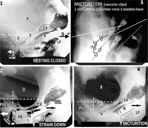 Mechanics of the urethral closure (continence) and opening (mcturition). X-ray 1: resting closed “S” denotes slow twitch muscle contraction of the three directional striated muscle forces, forwards PCM, backwards LP, downwards LMA (arrows) which contract against pubourethral ligament (PUL) anteriorly and uterosacral ligament (USL) posteriorly to close urethra distally and at bladder neck (6) CX, cervix; U, urethra; LP = levator plate muscle; PCM, pubococcygeus; LMA, conjoint longitudinal muscle of the anus; V, vagina; R, rectum; PB, perineal body. Radioactive dye has been inserted into vagina, rectum and levator plate. White broken lines = vertical and horizontal bony co-ordinates. X-ray 2: urethral closure during effort (coughing or straining). Compared to X-ray 1 (same patient), the forward muscle force (arrow) stretches the distal vagina (V) forwards against PUL to close the distal urethra, “urethral closure mechanism”; the backwards and downwards muscle forces (arrows), stretch and angulate the upper vagina and urethra around PUL to “kink” the proximal urethra, “bladder neck closure mechanism.” X-ray 3: micturition X-ray superimposed on resting xray patient sitting. Vascular clips have been applied to the midurethra “1.” Bladder neck “2” and bladder base “3.” Radio-opaque dye has been injected into the levator plate “LP,” which has been angulated downwards during micturition, as has the rectum “R,” which has 10 mL of barium paste. Broken lines indicate position of organs during micturition. Subscript “m” indicates the position of rectum “R” and levator plate “LP” during micturition. Note: backward extension of clips “2” and “3” indicating opening out of bladder neck and proximal urethra by LP/LMA contraction, and downward and forward movement of clip “1” indicating opening out of distal urethra by lateral/downward contracrtion of ischiocavernosus and bulbocavernosus muscles [9]. X-ray 4: the difference from straining (X-ray 2) is that the forward vector (“S” resting closed) relaxes. The backward/downward vectors stretch the vagina backwards and downwards against USL to open out the posterior urethral wall. The enlarged outlet exponentially decreases the resistance to evacuation by detrusor contraction inversely by the 4th power (Poiseuille’s Law). Comparing resting X-ray 1 with micturition X-rays 3 and 4: the distal urethra is pulled backwards from the vertical bony co-ordinate indicating PCM relaxation; angulation of the anterior portion of LP by downward LMA contraction pulls down rectum “R” and bladder base to “funnel” the bladder base and open the posterior wall of urethra.