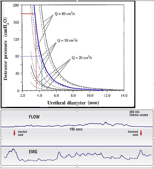 Narrowed urethra causes “obstructed micturition”: raised resistance, emptying pressure, and low flow. Upper figure: detrusor pressure at 3 different flow rates as a function of the urethral diameter for a tube length of 4 cm: frictional component: dotted line; dynamic component: dashed line; total: solid line. Blue curve: resistance to urine flow of 50 mL/s in the urethra, is exponentially determined, by the diameter of the urethra. Note: even a 0.5 mm change from 3.7 mm to 4.2 mm in urethral diameter reduces the detrusor pressure required to urinate at 50 mL/s from 180 cm H2O to 80 cm H2O. Opening to 6.0 mm (2.3 mm change) reduces detrusor pressure required to 20 cm H2O. Horizontal axis, urethral diameter; vertical axis = detrusor pressure required to drive the urine through the urethra. Lower figure: flow chart in a woman with “obstructed micturition” and an EMG electrode in the posterior fornix of vagina, recording contraction of the posterior opening muscles (LP and LMA). The EMG is activated before urine flow commences. Note continuous activation of the pelvic floor muscles.