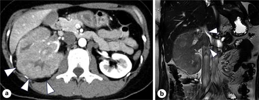 a Contrast-enhanced CT reveals a hypovascular renal tumor in the right kidney with a diameter of 116 × 83 mm. b MRI shows that the cranial extent of the tumor thrombus was below the hepatic vein inflow.