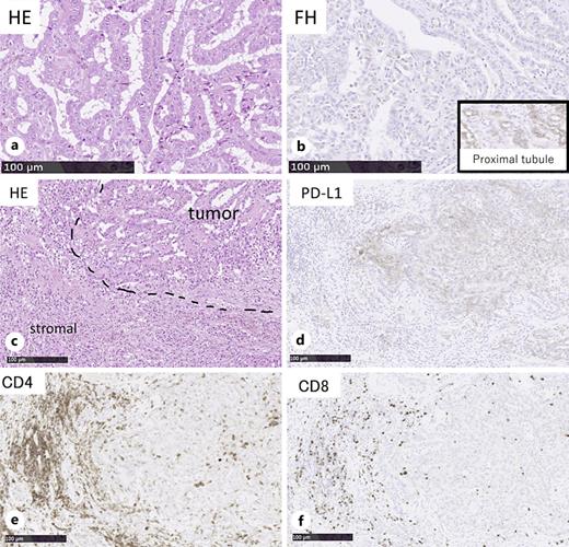 a Hematoxylin and eosin staining reveals highly atypical tumor cells with irregular glandular structures and prominent nucleoli resembling nuclear inclusions. b FH staining demonstrates a loss of FH protein in the tumor cells, with proximal tubules serving as the positive control for evaluation. c Hematoxylin and eosin stain illustrates the spatial relationship between the tumor and stroma (dotted lines). d PD-L1 staining indicates that PD-L1 is expressed on tumor cells. e, f CD4 and CD8-positive lymphocyte infiltrations are observed, predominantly in the stroma, with minimal infiltration within the tumor. FH: polyclonal rabbit anti-FH antibody (Sigma-Aldrich, HPA025770), CD8: monoclonal mouse anti-CD8 antibody, clone C8/144B (Histofine, Nichirei Biosciences), PD-L1: monoclonal mouse anti-PD-L1 antibody, clone 22C3 (PharmDx, Dako).