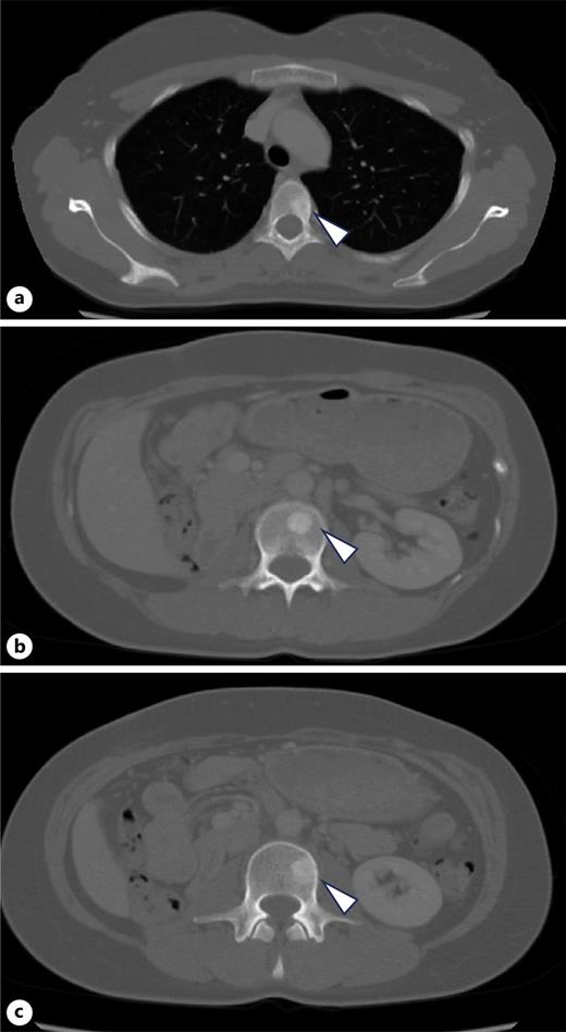 Multiple bone metastases that had not been detected on CT before the initiation of adjuvant therapy. a Th4. b L2. c L3.