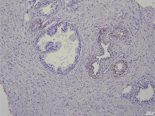 Immunohistochemistry in prostate tissue without carcinoma and with basal cell hyperplasia.