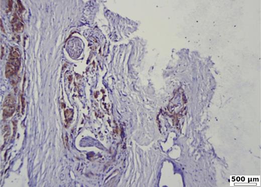 Strong BSP expression of 90% in poorly differentiated prostate carcinoma (G3, ISUP 5), with capsular and perineural invasion. Immunohistochemistry BSP.
