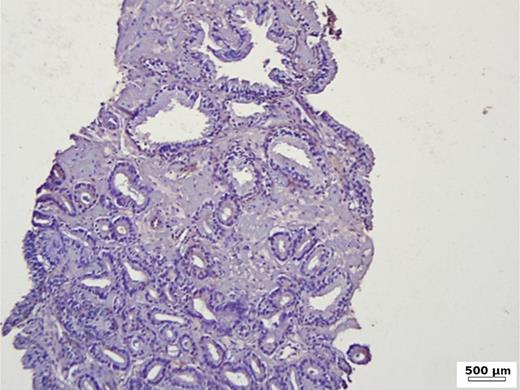 Low BSP expression (20%) in a moderate differentiated acinar prostate carcinoma (G2, ISUP 2). Immunohistochemistry BSP.