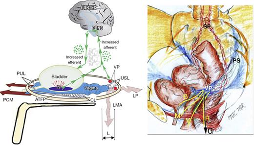 “Simulated operation” relieves pain and urge by supporting USL. Left: 3D view of the PUL and USL attachments to the pelvic brim. A gently inserted speculum mechanically supports lax USLs and pelvic visceral nerve plexuses (VP). The test, if successful, decreases afferent pain and urge impulses; the patient reports lessening pain in multiple sites, for example, “B,” “R,” and “M” (right image). Co-occurring urge is also often relieved by speculum support of urothelial stretch receptors “N.” Right: 3D view of pelvic organs. The VP comprises sympathetic plexus (SP) and parasympathetic plexus (PS). The yellow lines represent visceral nerves to and from the end organs. M, muscles; V, vagina/vulva; B, bladder; R, rectum; G, force of gravity acting on “VPs” (left figure); PCM, pubococcygeus muscle; PUL, pubourethral ligament; ATFP, arcus tendineus fascia pelvis; USL, uterosacral ligament; CL, cardinal ligament; LP, levator plate; LMA, conjoint longitudinal muscle of the anus; L, USL laxity.